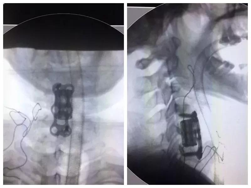 高位截瘫3d打印疗法,高位截瘫奇迹恢复
