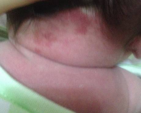 宝宝常见胎记草莓斑,宝宝胎记皮脂腺痣