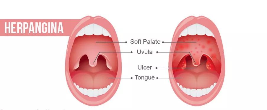 孩子呕吐发烧反反复复,孩子恶心想吐发高烧