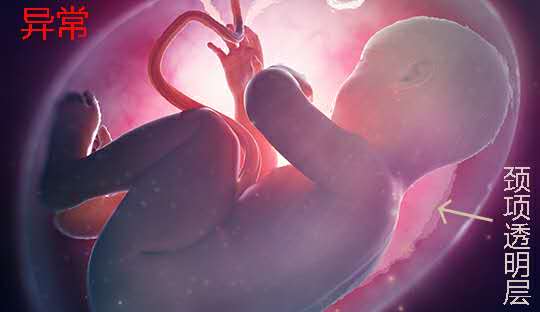 孕早期nt检查胎儿不动怎么才能动,孕早期先做nt还是先建档检查