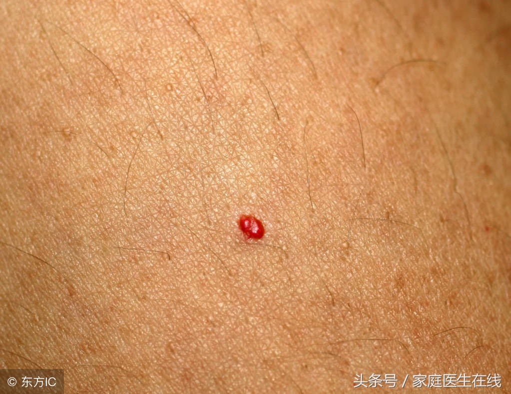 手上起小红点儿是什么,手上起小红点还痒是什么病