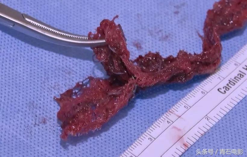 4公分线圈可避孕，护士曾为其代言，但纪录片上映后产品遭停售！