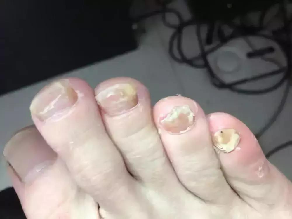 听信偏方的例子,听信偏方治脚气