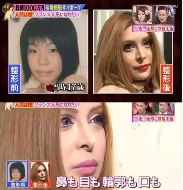 韩式整容全过程,日式整容和韩式整容