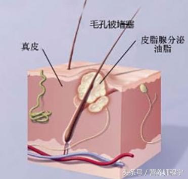 下巴不停冒脓包型痘痘药膏,下巴下面有痘痘冒白头