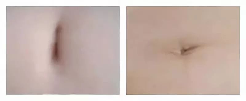 肚脐补元气最快的方法,健康的肚脐长什么样