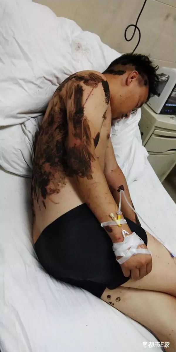 被马蜂蜇了的最快速处理办法,被马蜂蛰的100种方法