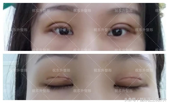 实例：全切双眼皮术后15天变化全程记录