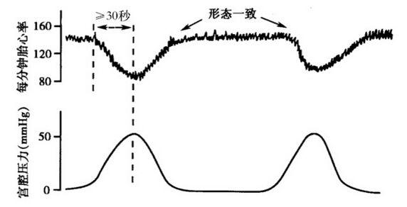 胎心监护有胎心减速是什么原因,胎心监护曲线高低变化大怎么回事