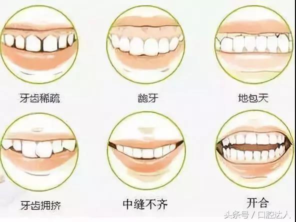 一颗牙怎么自己矫正,一颗牙怎么补那么多次才完成