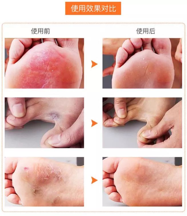 脚气奇痒难忍只需用它泡脚,去脚气脚臭痒最好最快办法