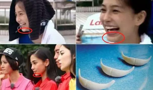 下巴填充和假体植入哪个好,下巴填充膨体跟硅胶哪个更好