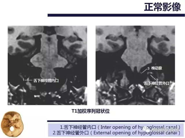 舌下神经和舌咽神经的解剖图,颊神经舌神经解剖图