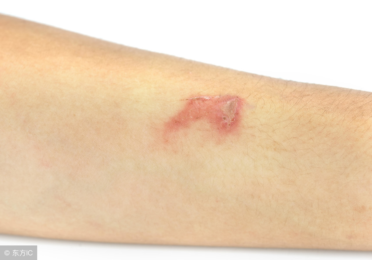 带状疱疹治疗方法和注意事项,带状疱疹治疗方法与注意事项