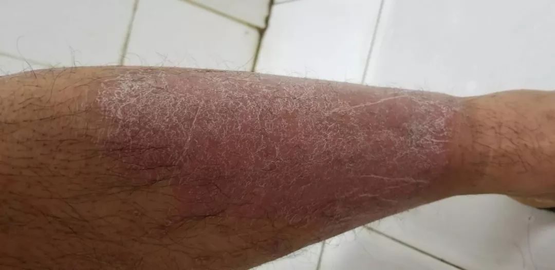 娴欐睙鐪佷腑鍖绘不鐤楅摱灞戠梾,鍏勫紵淇╅兘寰楃櫧鐧滈