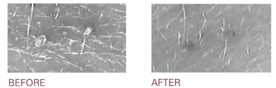 战痘技巧｜林允儿和小甜甜的痘痘可不是一回事