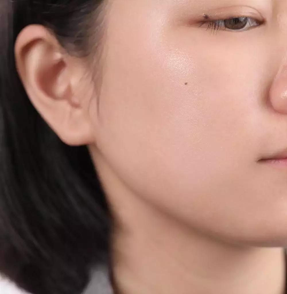 战痘的四个小方法,战痘女孩的秘笈