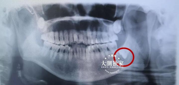 别把牙疼不当回事！海宁7个月孕妇因此痛失宝宝