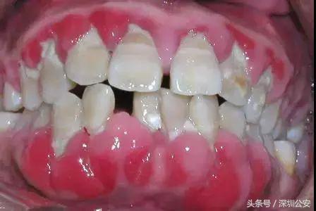 禁毒减肥法图片大全,禁毒减肥法图片