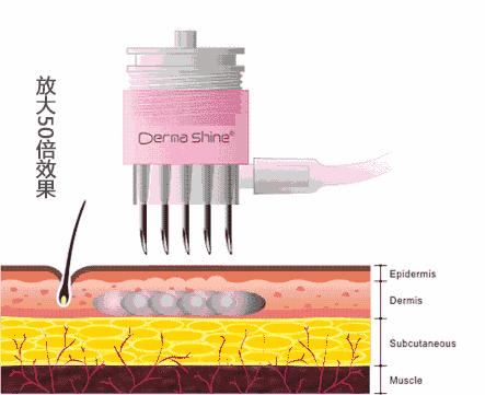 痘印修复越来越明显,痘印痘坑怎么修复前后对比