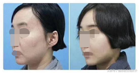 25岁脸皮肤松弛该怎么改善,脸皮肤松垮怎么补救