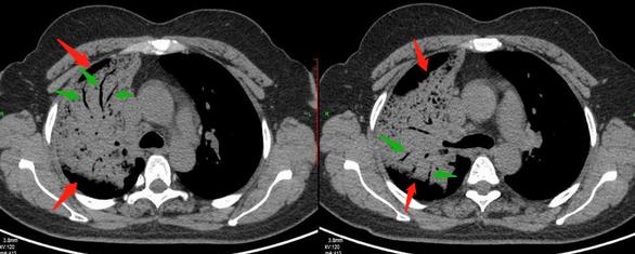 咳嗽几个月都没好会得肺癌吗,29岁女孩咳嗽一周肺癌
