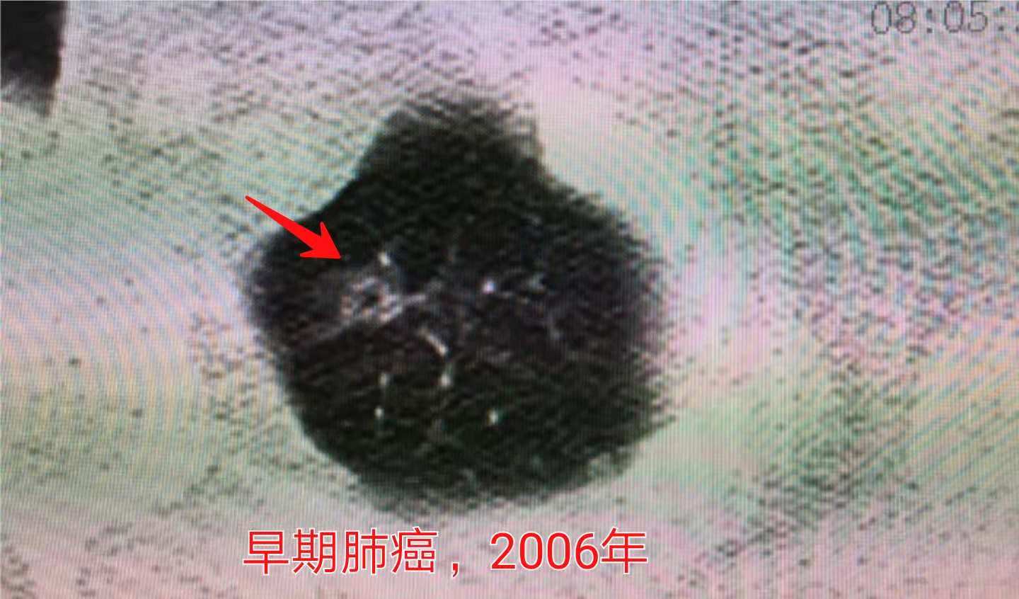 咳嗽几个月都没好会得肺癌吗,29岁女孩咳嗽一周肺癌