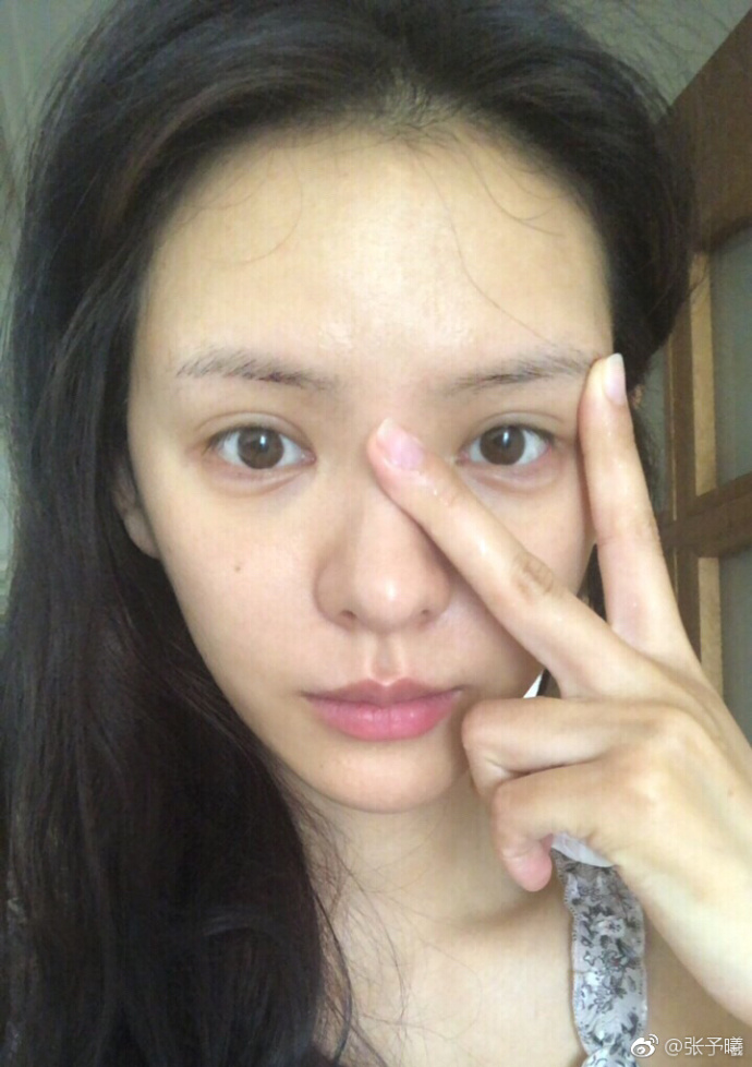 马东眼袋消除前后对比,马东去眼袋效果