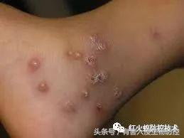 被红火蚁咬的治疗方法,被红火蚁咬后怎么处理偏方