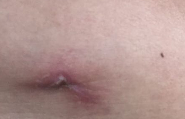 肾囊肿手术二十八天,肾囊肿切除手术失败