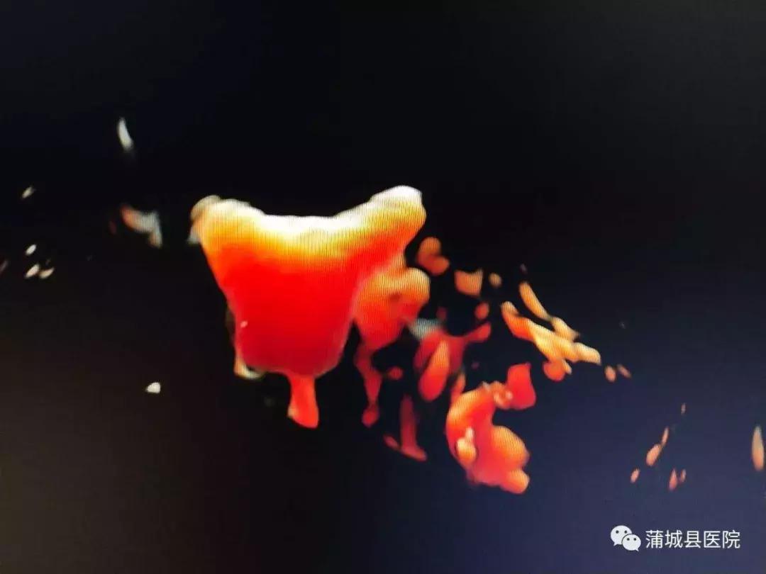 蒲城县做造影,蒲城县妇科超声