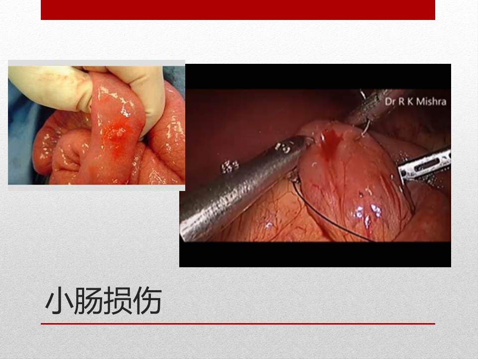泌尿外科腹腔镜手术适应症,泌尿外科腹腔镜并发症