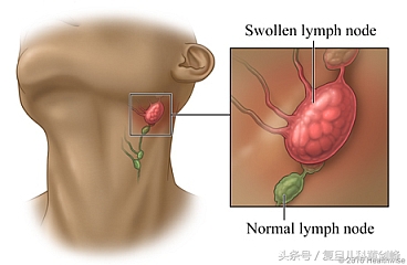 宝宝脖子上有个小疙瘩是什么,四个月宝宝脖子两侧摸着有小疙瘩