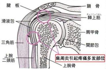 肩周炎与周围肌肉损伤的治疗,肩周炎加肌腱损伤有什么方法治疗