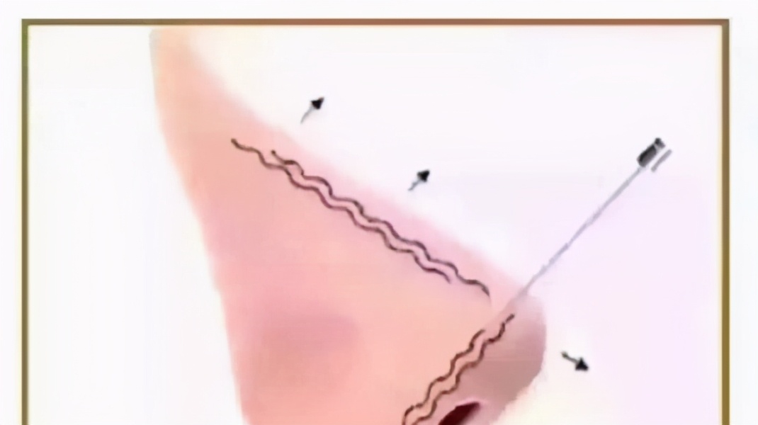 什么是线雕哪些医院能做,哪些人不能做线雕鼻