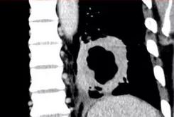73岁老人肺上长3个结节有事吗,70多岁老人肺部有个拳头大的肿块