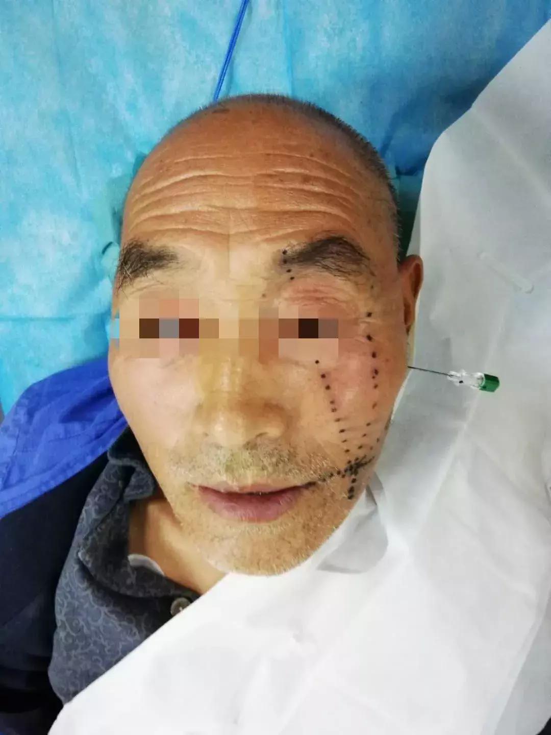 射频消融术治疗三叉神经痛,射频热凝治疗三叉神经痛成功案例