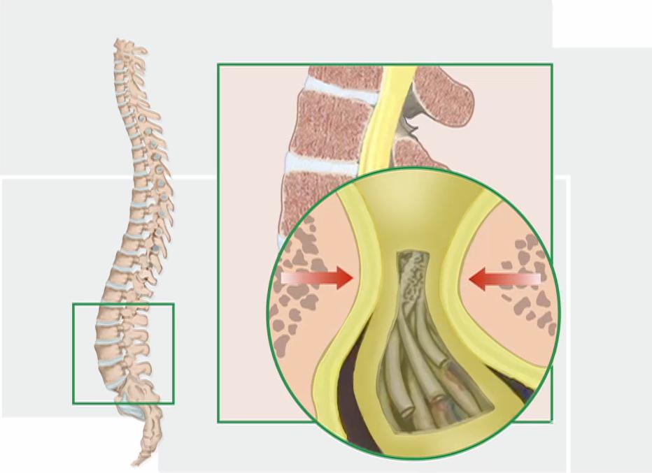 老人家腰椎盘狭窄怎么治疗,腰椎狭窄年轻人怎么治疗