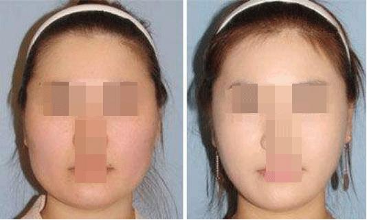 激光溶脂瘦脸要做几次效果最好,激光溶脂瘦脸多久见效