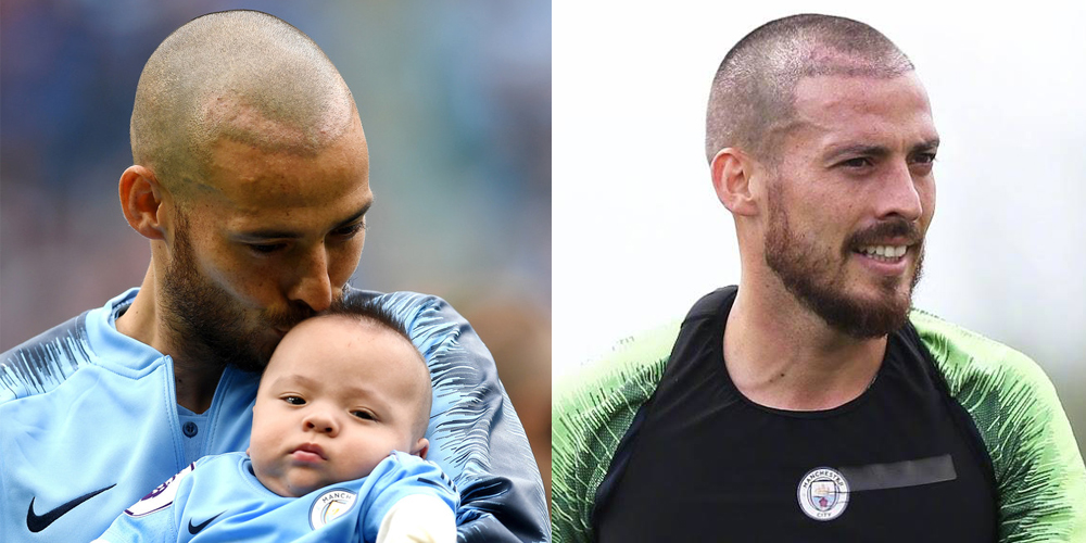 大卫席尔瓦为什么剃光头？