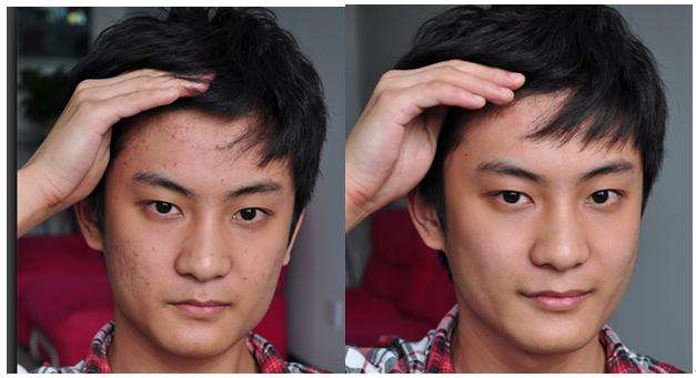 悄然流行的祛痘神器：珂玥（coco）老师的“3×1定期跟踪疗法”