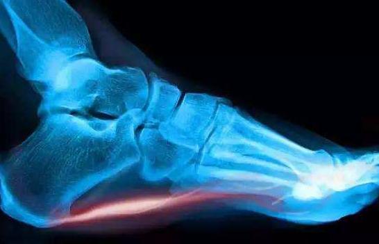 脚后跟长骨刺疼痛怎么缓解,脚后跟骨刺特别疼的最佳治疗方法