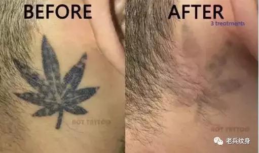 科普洗纹身的那些事儿,洗纹身误区以及洗纹身真实案例