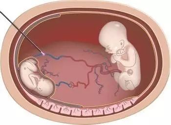 hcg值100多是宫外孕能看到包块吗,hcg2000做阴超看得出宫内宫外吗