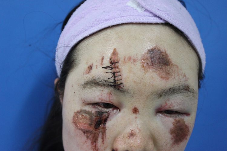 面部外伤后初期疤痕凸起怎么修复,面部外伤凹陷疤痕怎么去除