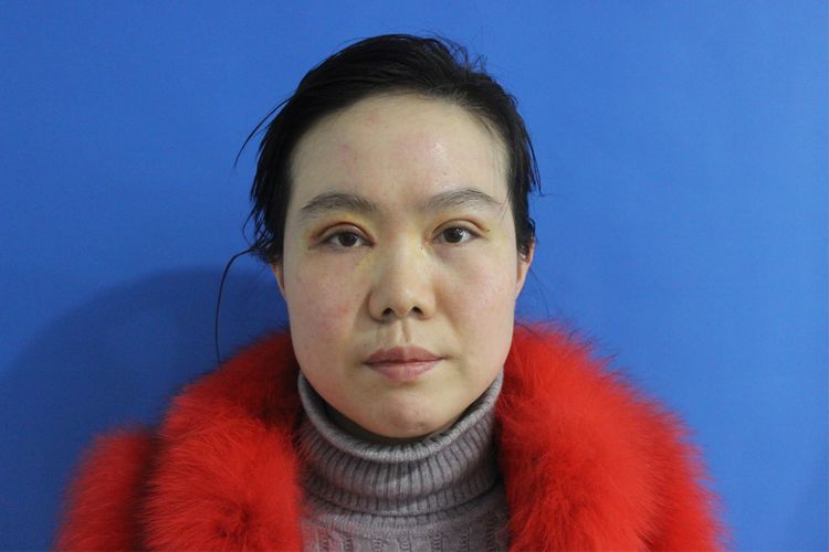 面部外伤后初期疤痕凸起怎么修复,面部外伤凹陷疤痕怎么去除