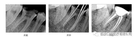根管治疗的步骤有哪些,根管治疗全过程步骤视频