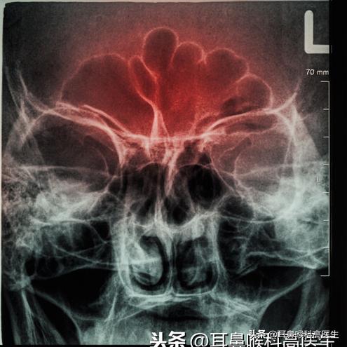 鼻窦炎为什么会头痛图解,鼻咽癌头痛和鼻窦炎头痛的区别