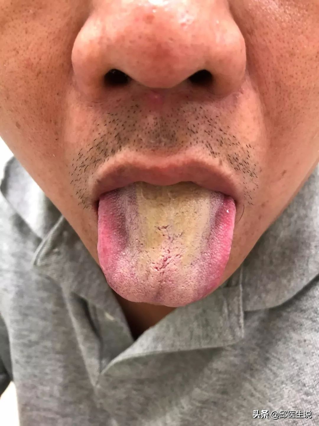 解决身体的湿气的偏方,本人湿气较重怎么能快速除湿气