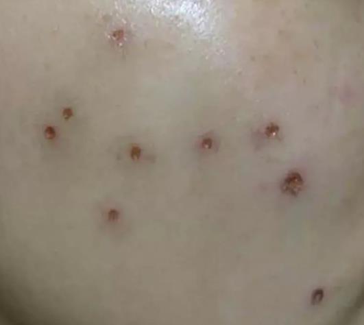 路边摆摊点痣用什么点痣,路边点痣真的可靠吗